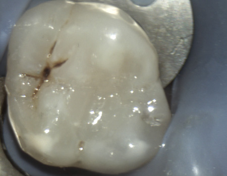 amalgam in tooth gone